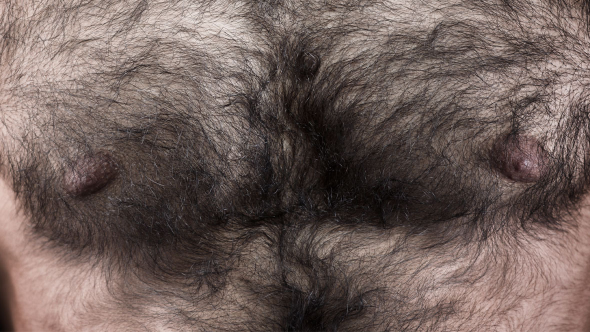 Discover more than 75 excessive body hair male